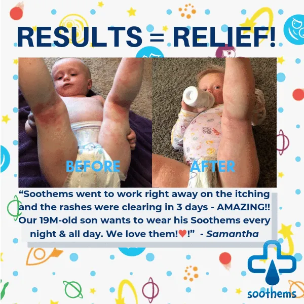 Soothems Eczema Sleeves For Children, Babies and Toddlers. May Also Be Used as Wet Wrap Sleeves for Arms or Legs Itch Relief