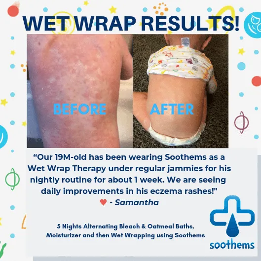 Soothems Eczema Sleeves For Children, Babies and Toddlers. May Also Be Used as Wet Wrap Sleeves for Arms or Legs Itch Relief