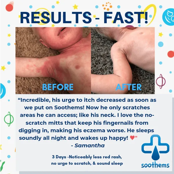 Soothems Eczema Sleeves For Children, Babies and Toddlers. May Also Be Used as Wet Wrap Sleeves for Arms or Legs Itch Relief